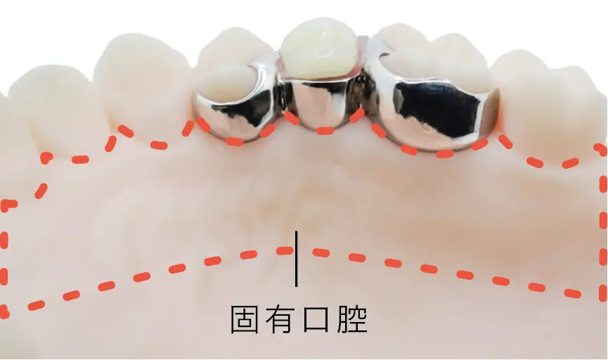 下あごの模型に付けたコンティースを内側から見た写真。チタンの部品が歯の内側に沿っています