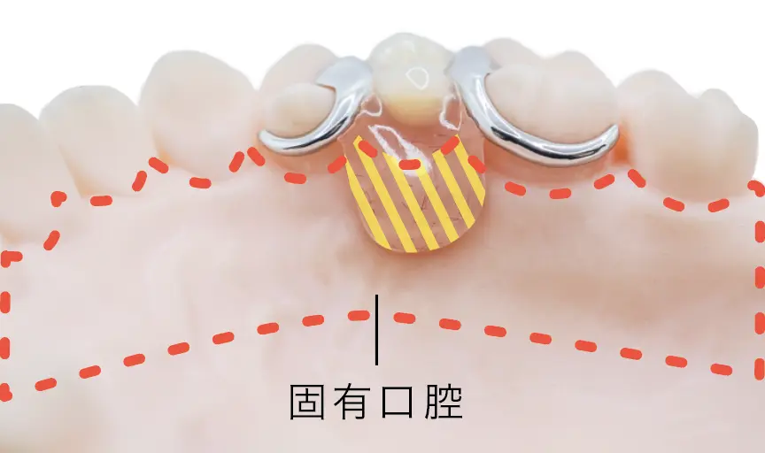 下あごの模型に付けた一般的な部分入れ歯を内側から見た写真。金属のバネと、舌のある側に出た歯ぐき色の部分(黄色の斜線)があります